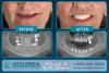 full mouth dental implants croatia